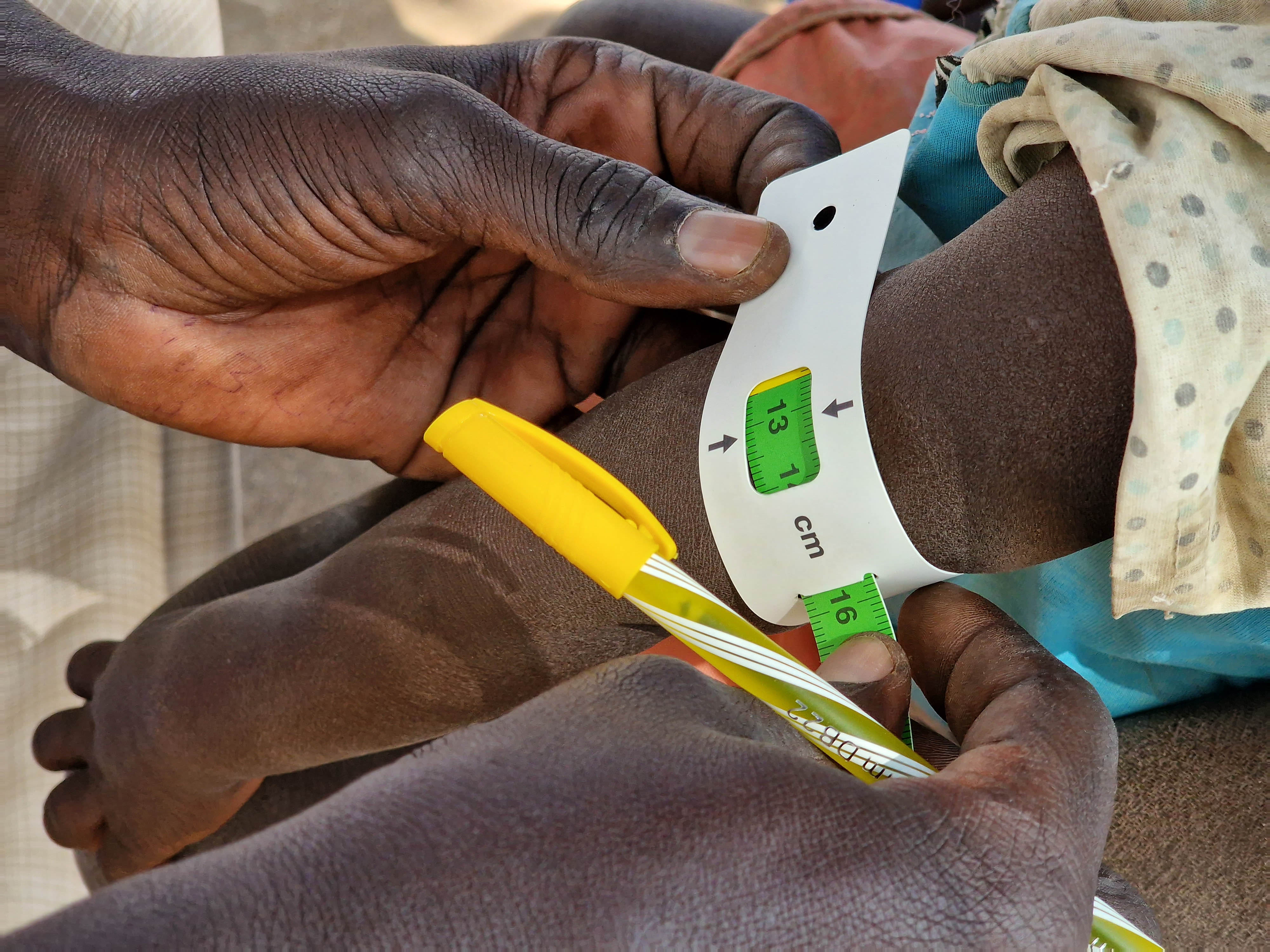 A child being examined at the OTP site in Aweil South, South Sudan, using MUAC tape