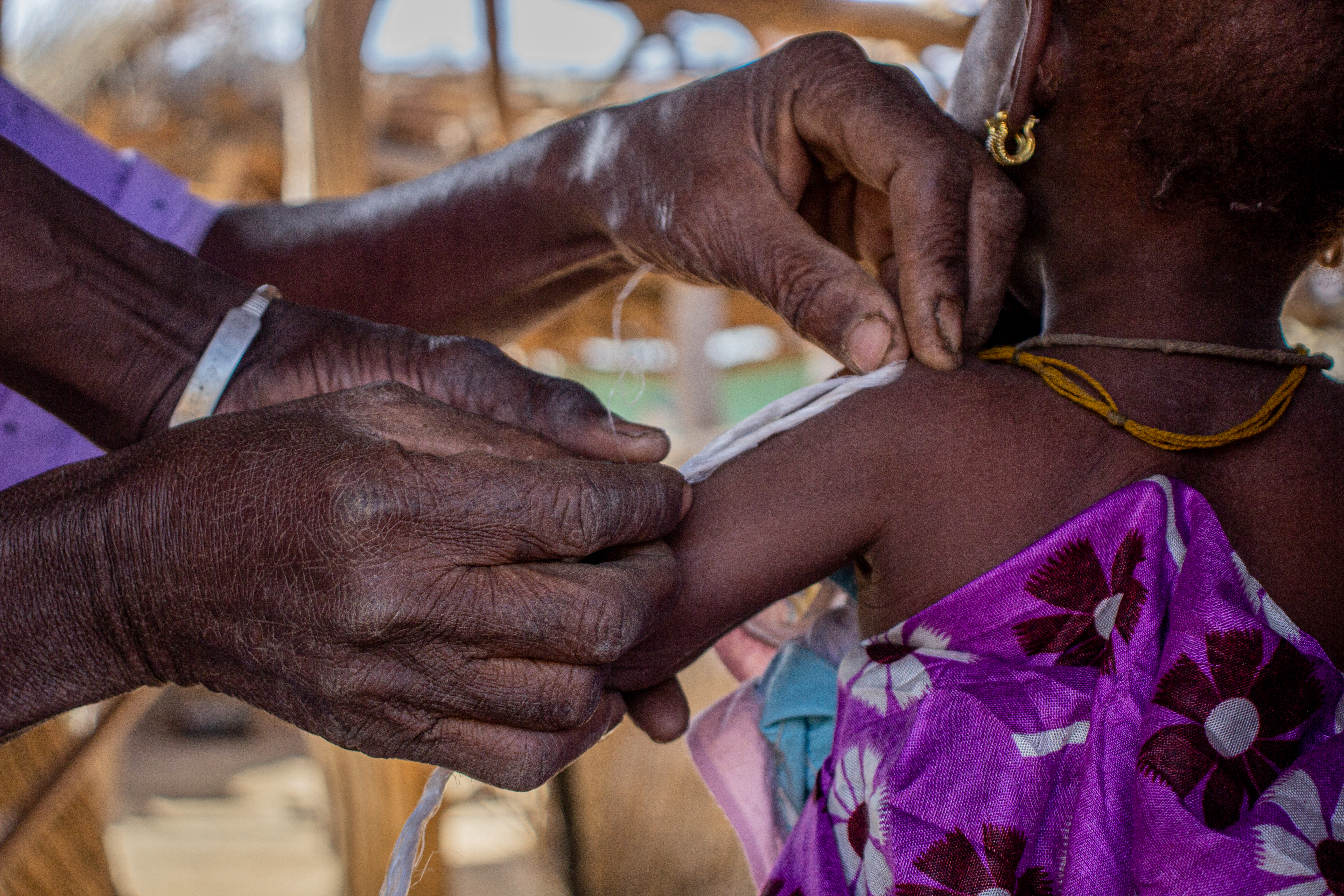 A community health worker measures a child's MUAC at intake for our randomized controlled trial in Mali.